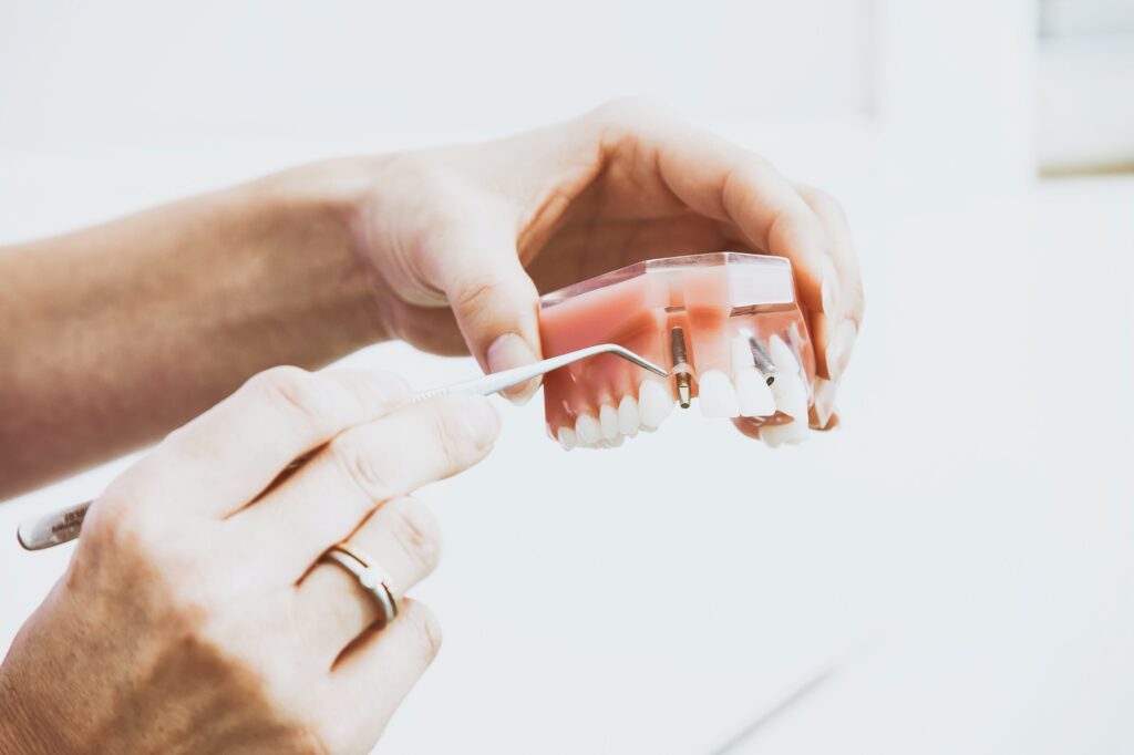 Common Reasons for Dental Implants